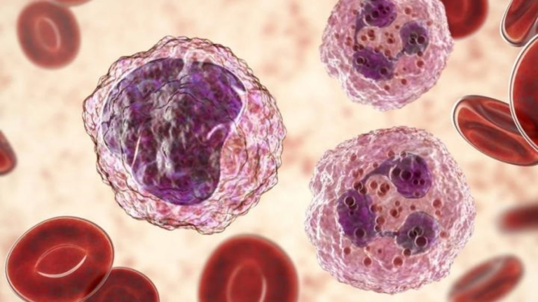 Leucemia Linfocítica Crónica, una enfermedad de la sangre que no siempre requiere tratamiento