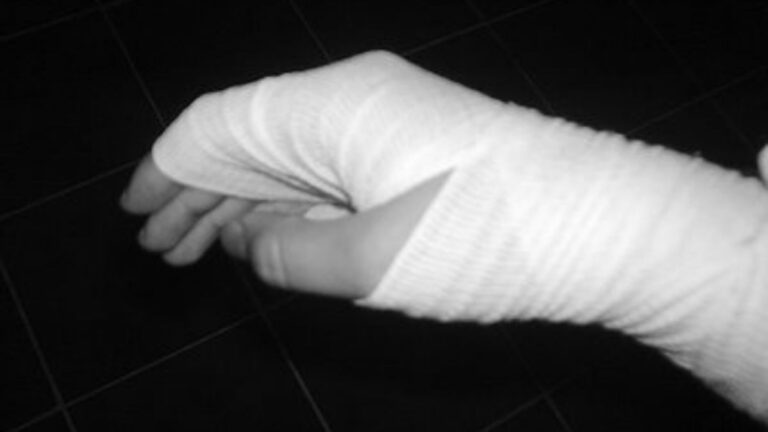 Le quemaron las manos a un niño e investigan si fue una venganza contra su padre